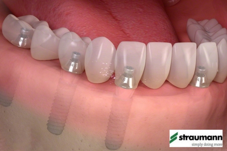 Implants Leicester Straumann